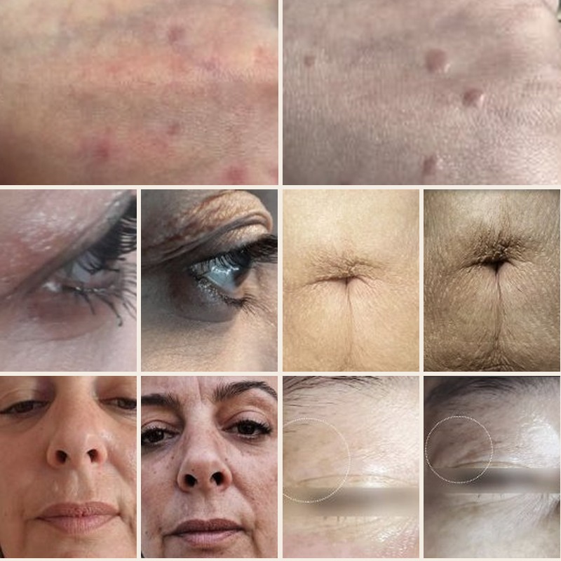 Before and after treatment results: moles, eye bags, wrinkles, anti-aging, scars